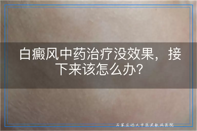 白癜风中药治疗没效果，接下来该怎么办？