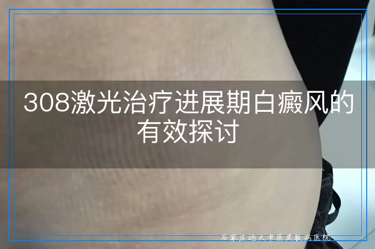 308激光治疗进展期白癜风的有效探讨