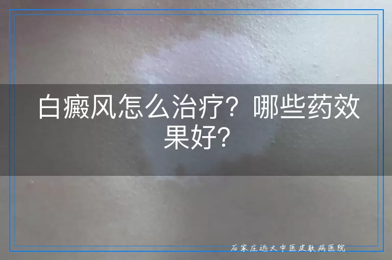白癜风怎么治疗？哪些药效果好？