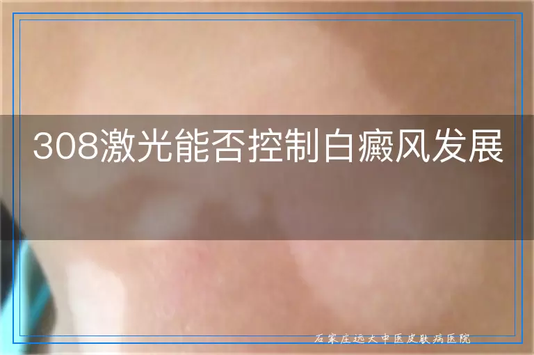 308激光能否控制白癜风发展