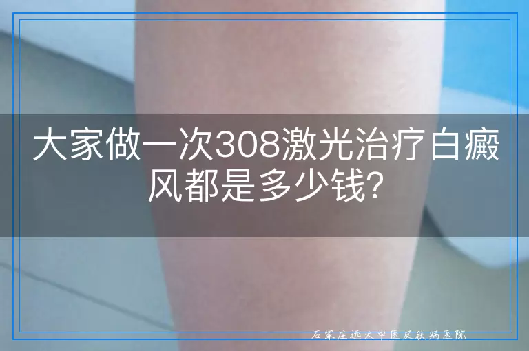 大家做一次308激光治疗白癜风都是多少钱？