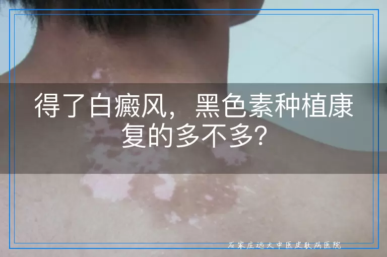 得了白癜风，黑色素种植康复的多不多？