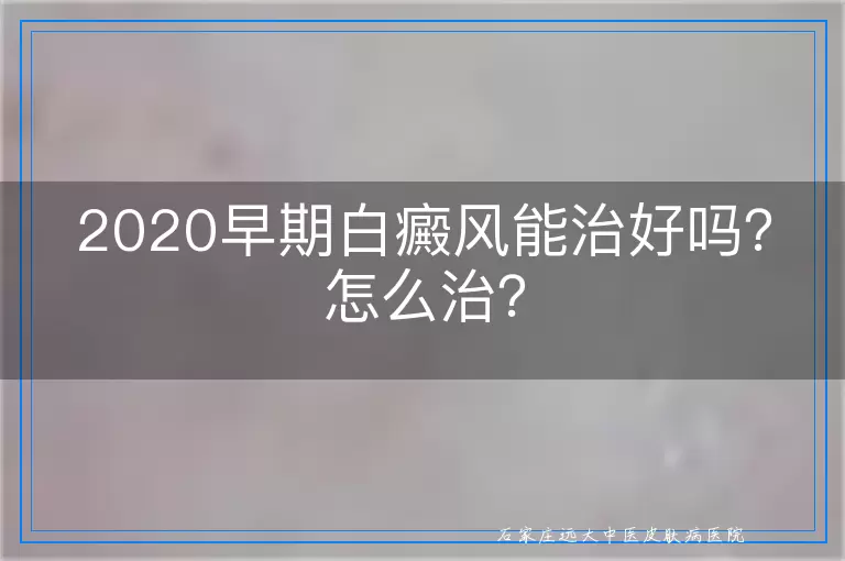 2020早期白癜风能治好吗？怎么治？