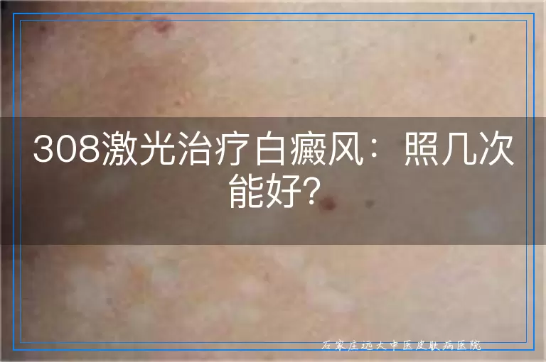 308激光治疗白癜风：照几次能好？