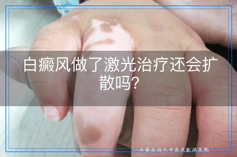 白癜风做了激光治疗还会扩散吗？