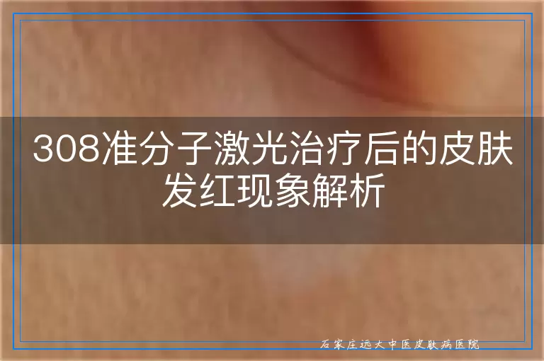 308准分子激光治疗后的皮肤发红现象解析