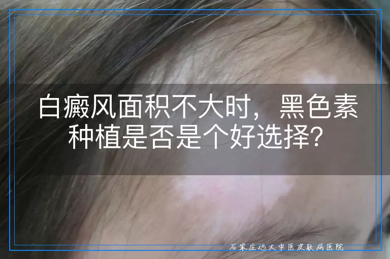 白癜风面积不大时，黑色素种植是否是个好选择？
