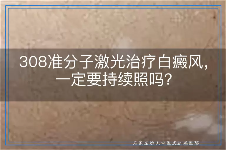 308准分子激光治疗白癜风，一定要持续照吗？