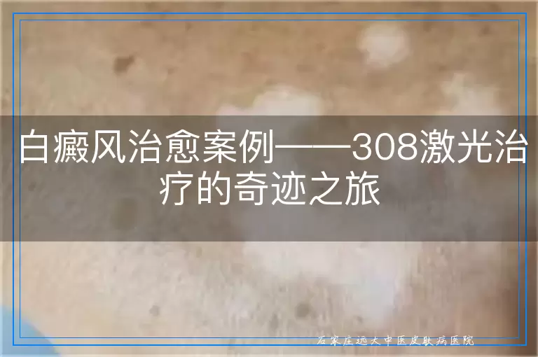 白癜风治愈案例——308激光治疗的奇迹之旅