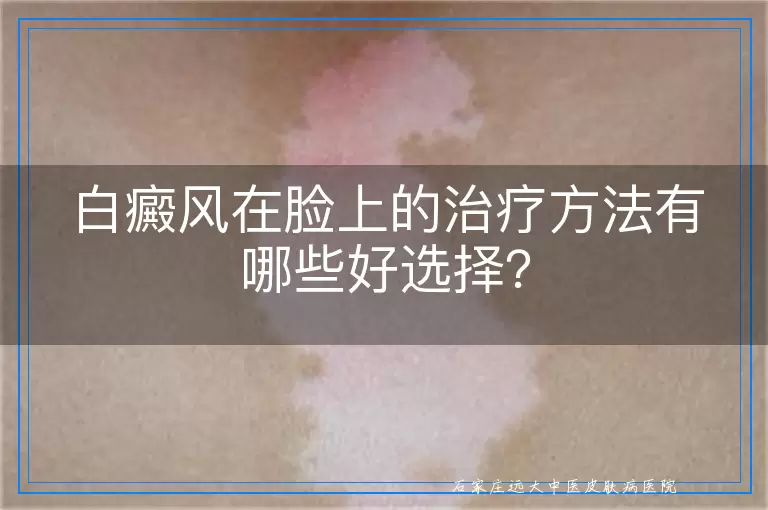 白癜风在脸上的治疗方法有哪些好选择？