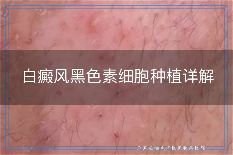 白癜风黑色素细胞种植详解