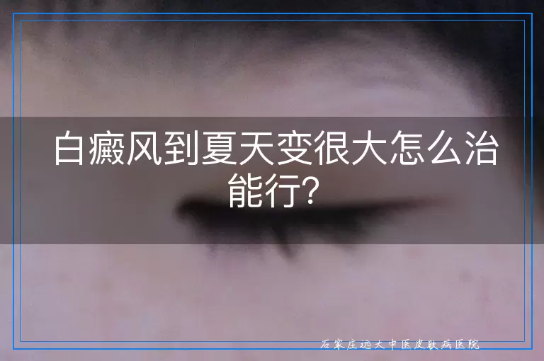 白癜风到夏天变很大怎么治能行？