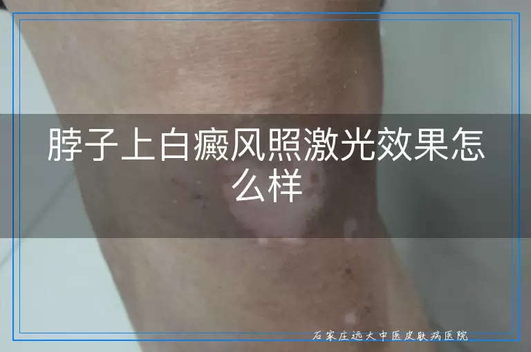 脖子上白癜风照激光效果怎么样