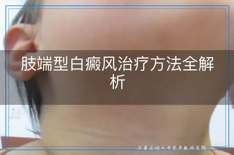 肢端型白癜风治疗方法全解析