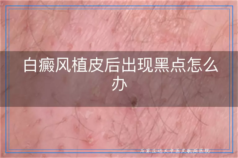 白癜风植皮后出现黑点怎么办