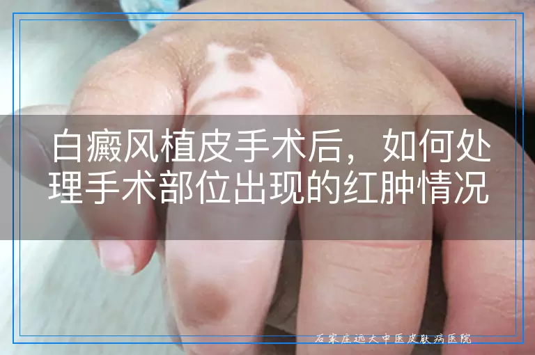 白癜风植皮手术后，如何处理手术部位出现的红肿情况