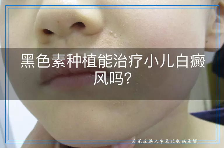 黑色素种植能治疗小儿白癜风吗？