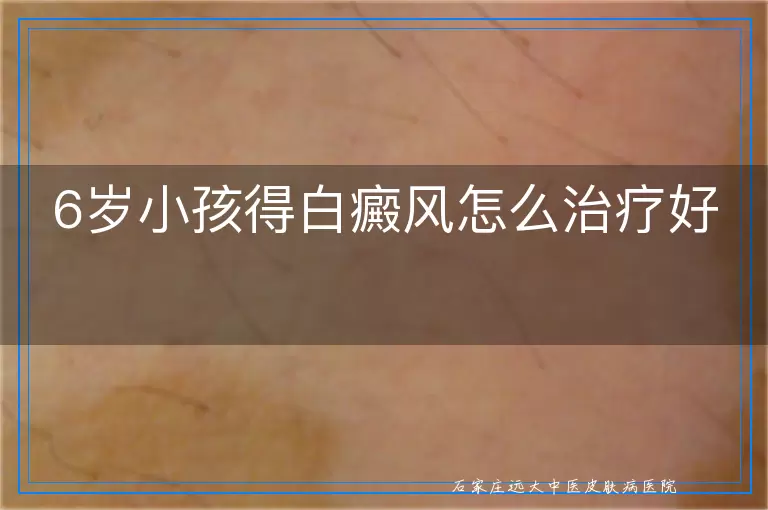 6岁小孩得白癜风怎么治疗好