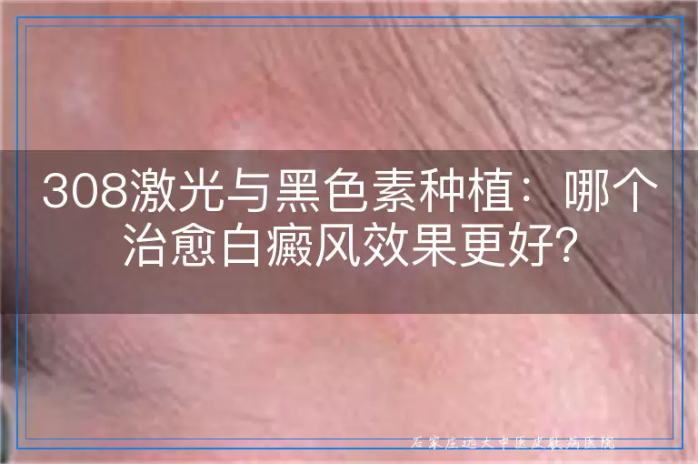 308激光与黑色素种植：哪个治愈白癜风效果更好？
