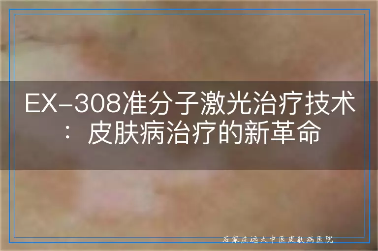 EX-308准分子激光治疗技术：皮肤病治疗的新革命