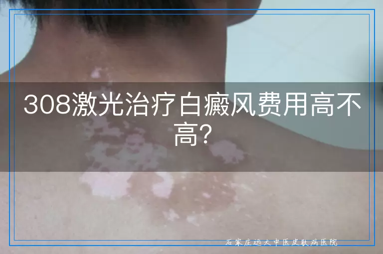 308激光治疗白癜风费用高不高？