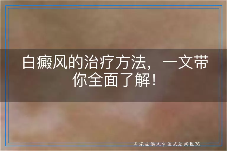 白癜风的治疗方法，一文带你全面了解！