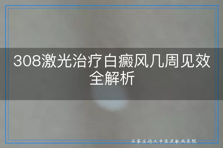308激光治疗白癜风几周见效全解析
