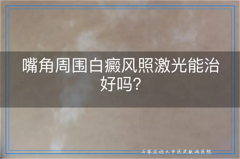 嘴角周围白癜风照激光能治好吗？
