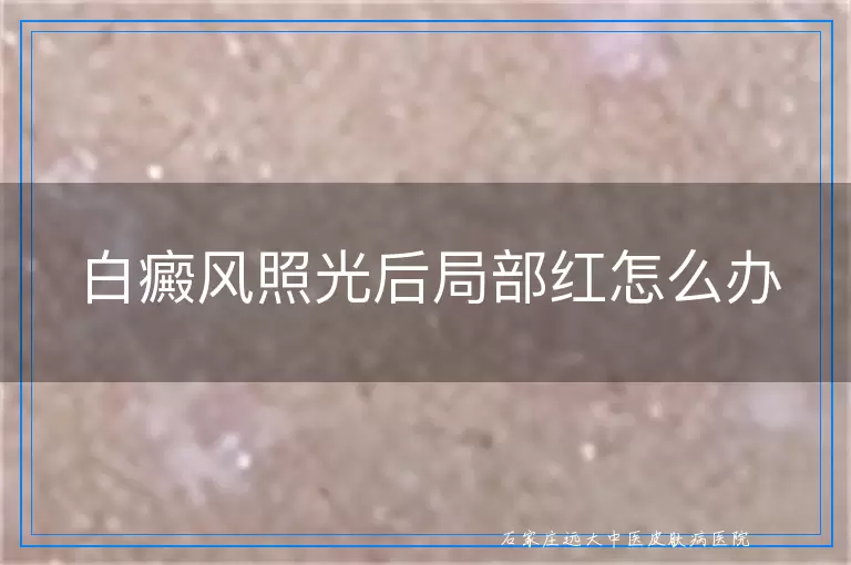 白癜风照光后局部红怎么办