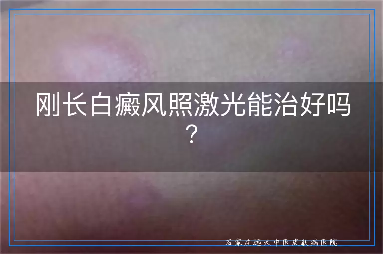 刚长白癜风照激光能治好吗？