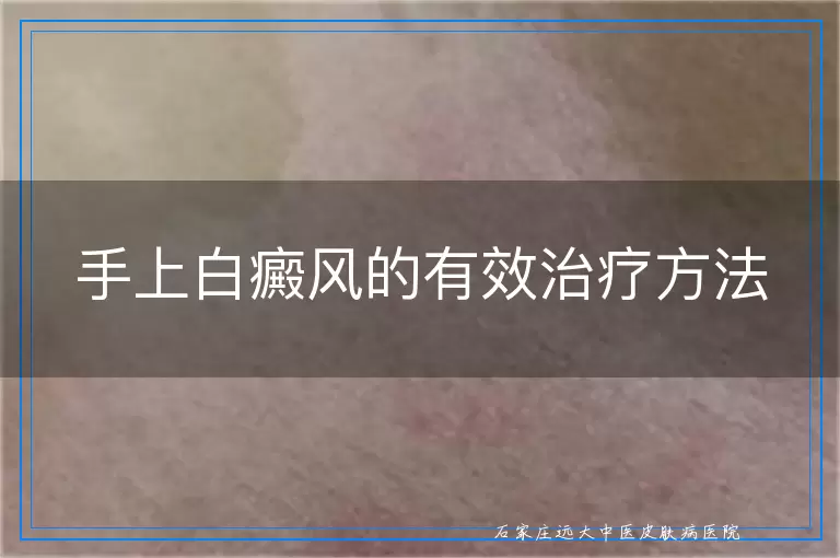 手上白癜风的有效治疗方法