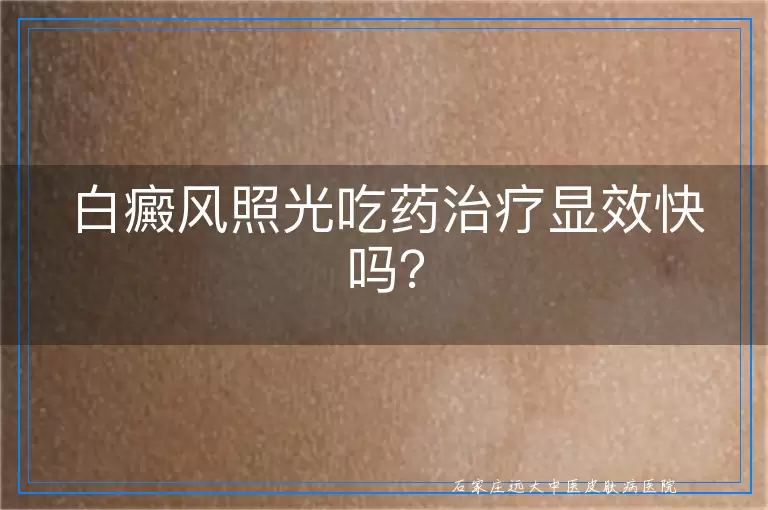 白癜风照光吃药治疗显效快吗？