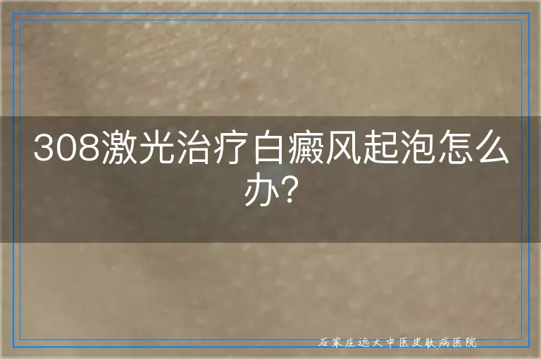 308激光治疗白癜风起泡怎么办？