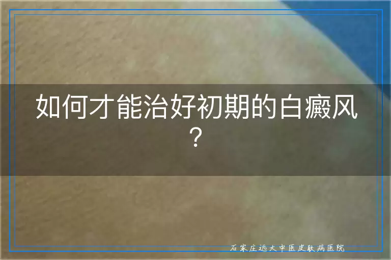 如何才能治好初期的白癜风？