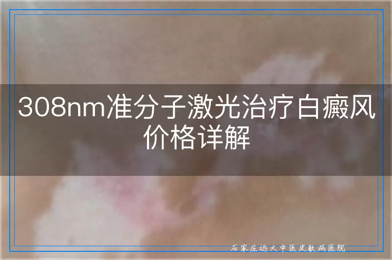 308nm准分子激光治疗白癜风价格详解