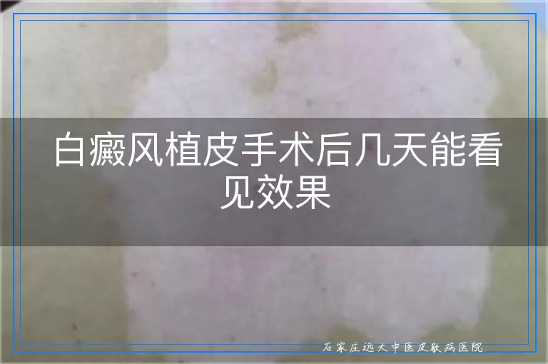 白癜风植皮手术后几天能看见效果