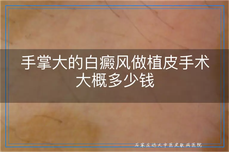 手掌大的白癜风做植皮手术大概多少钱