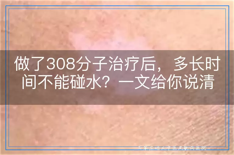 做了308分子治疗后，多长时间不能碰水？一文给你说清楚