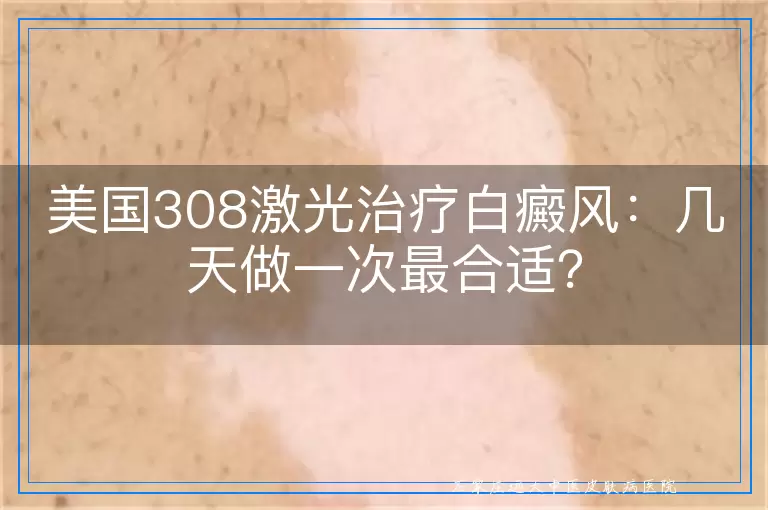 美国308激光治疗白癜风：几天做一次最合适？