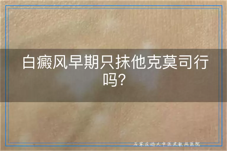白癜风早期只抹他克莫司行吗？