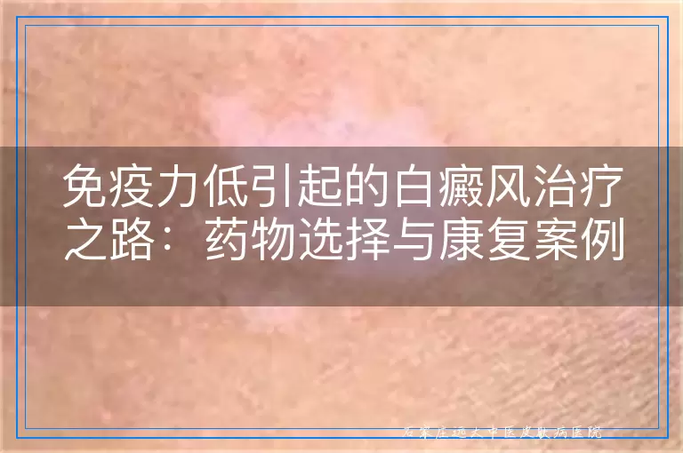 免疫力低引起的白癜风治疗之路：药物选择与康复案例