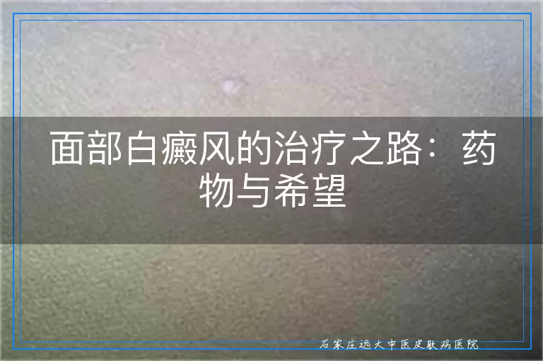 面部白癜风的治疗之路：药物与希望