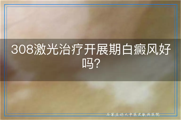 308激光治疗开展期白癜风好吗？
