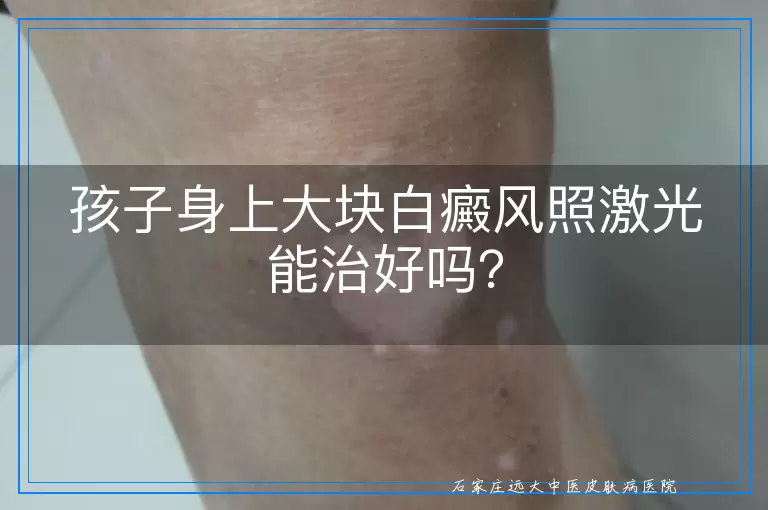 孩子身上大块白癜风照激光能治好吗？