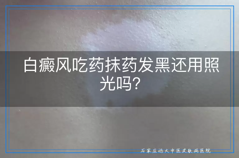 白癜风吃药抹药发黑还用照光吗？