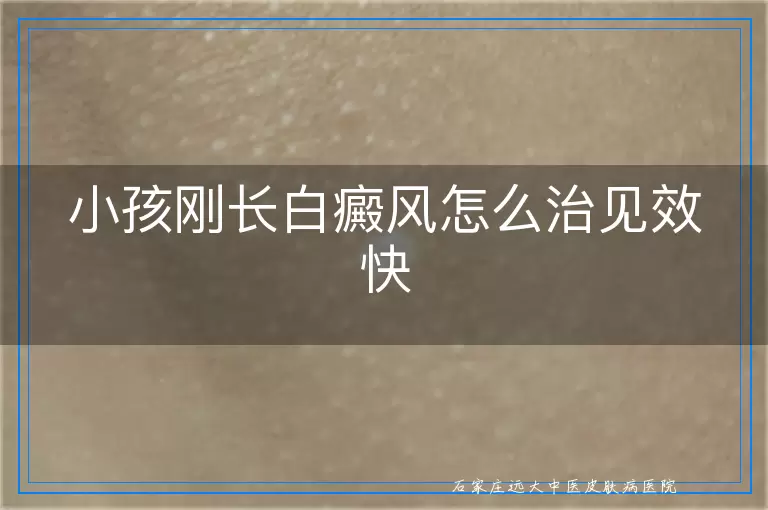 小孩刚长白癜风怎么治见效快