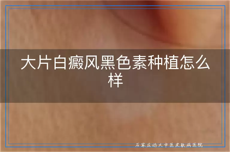 大片白癜风黑色素种植怎么样