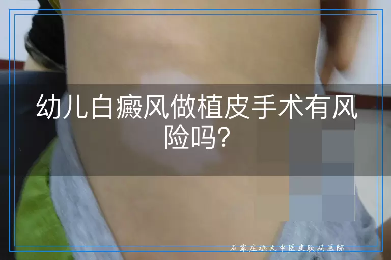 幼儿白癜风做植皮手术有风险吗？
