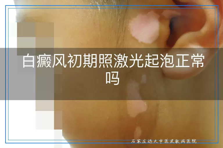 白癜风初期照激光起泡正常吗