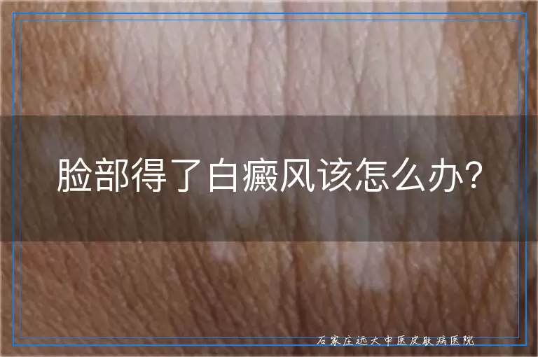脸部得了白癜风该怎么办？